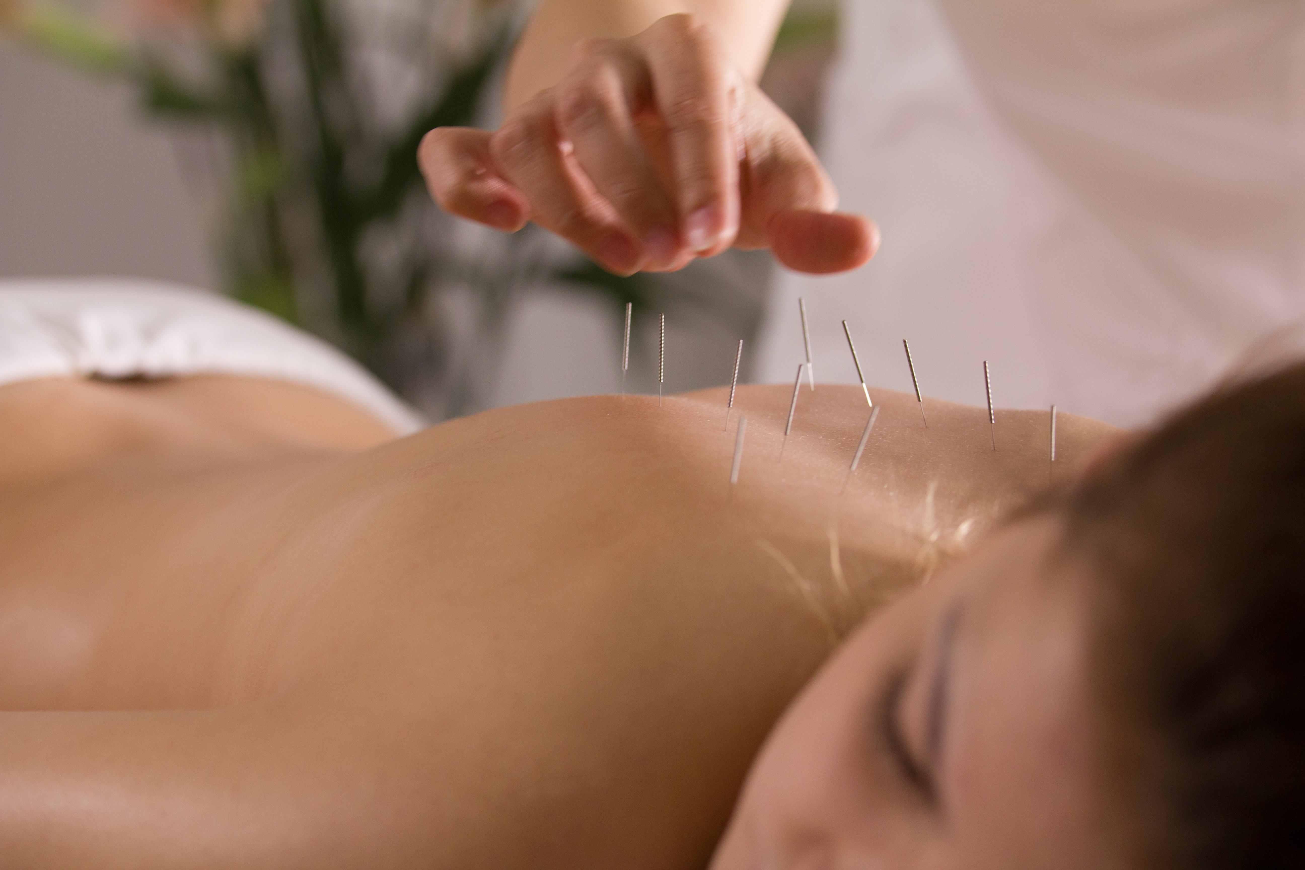 Acupuncture therapy